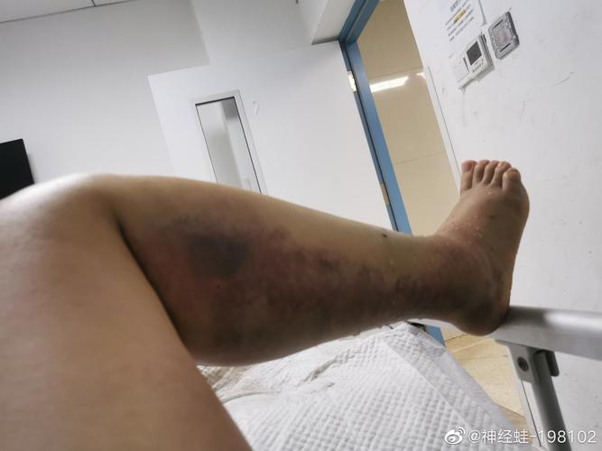 澳门管家婆100%精准香港和女子遭毒蛇咬伤身亡与女子遭毒蛇咬伤身亡视频